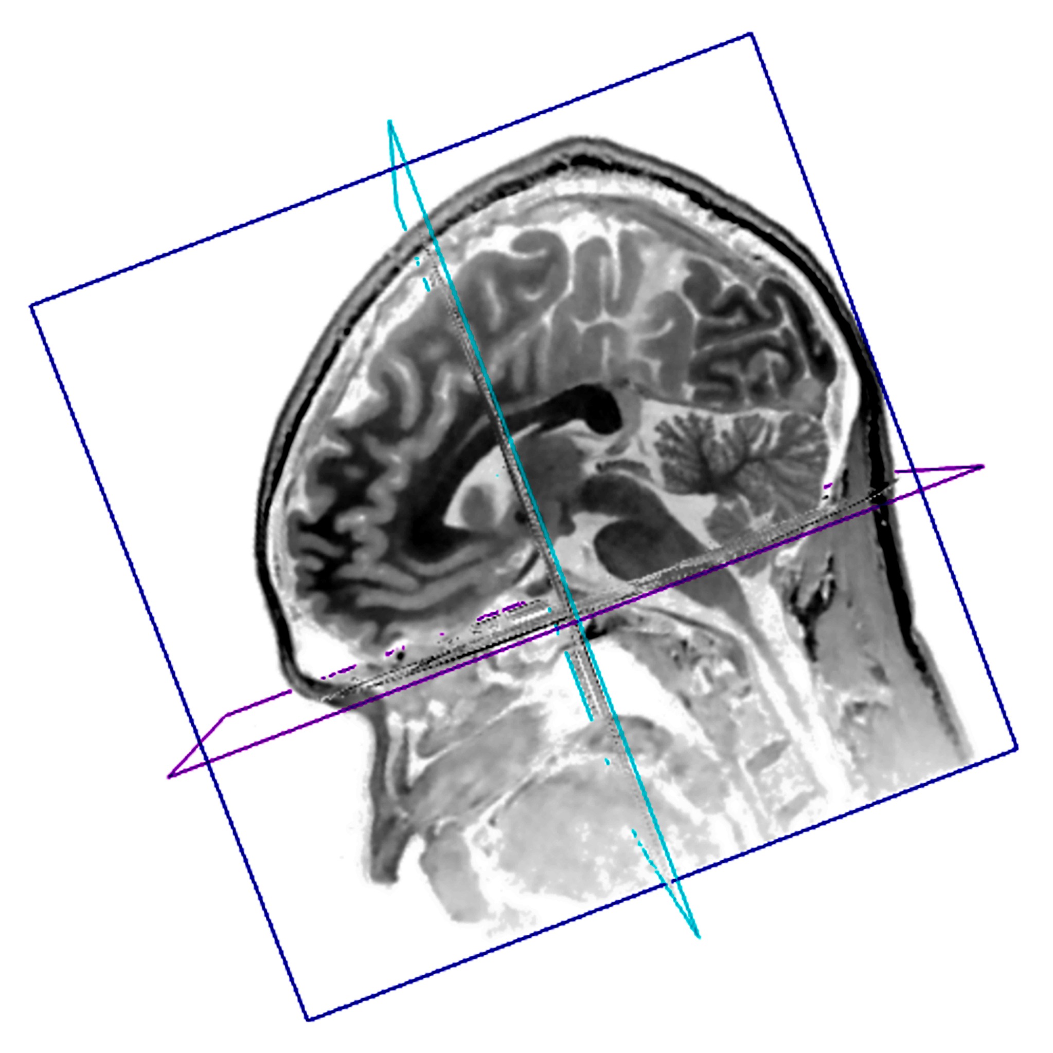 MRI image used within the Memory Fog project statement.
